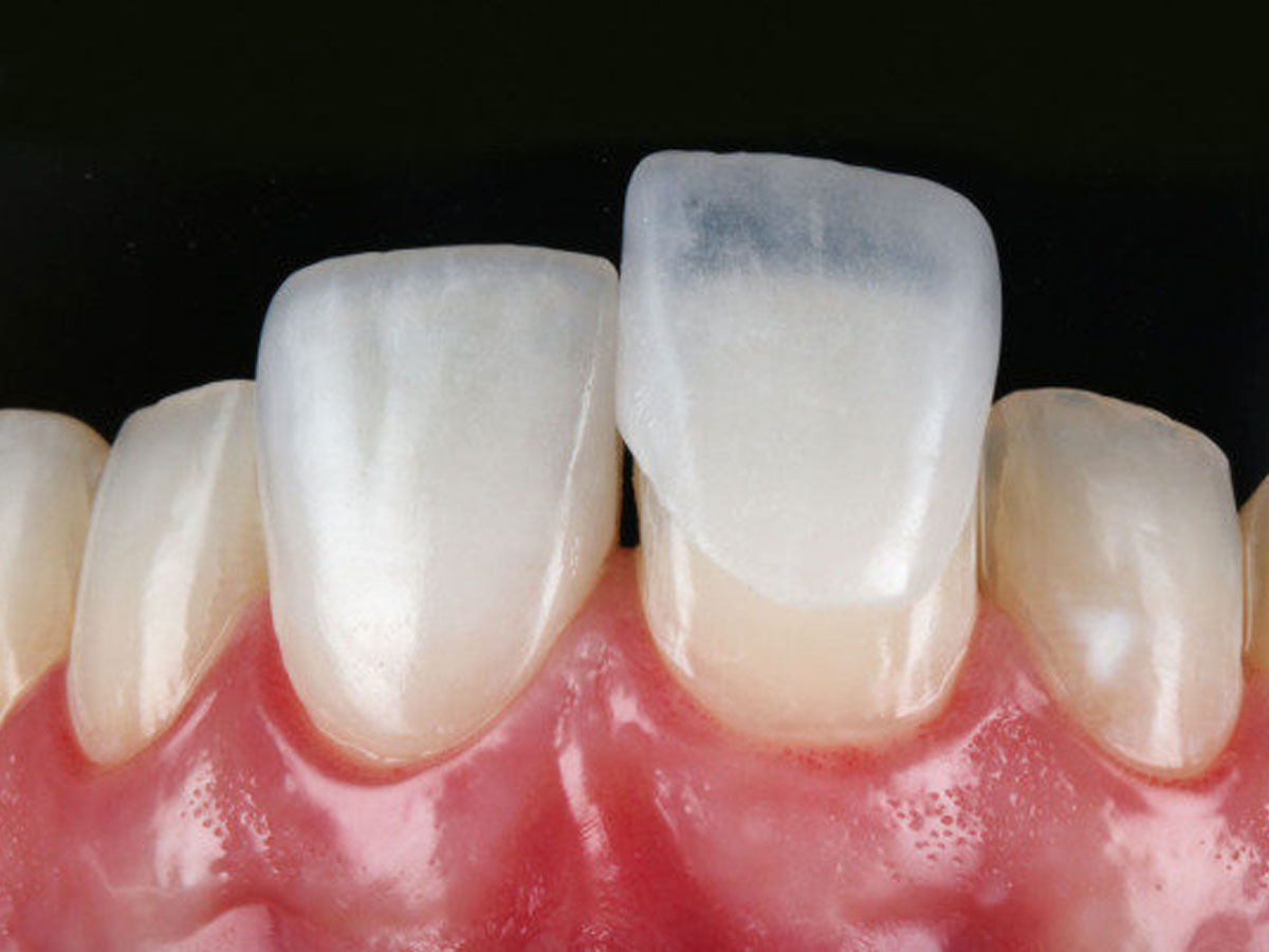 Lente de contato dental