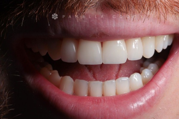 Imagem 1 das características para obter um sorriso bonito