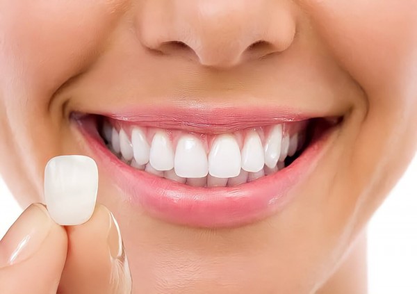 Imagem da etapa 5 do procedimento de lente de contato dental