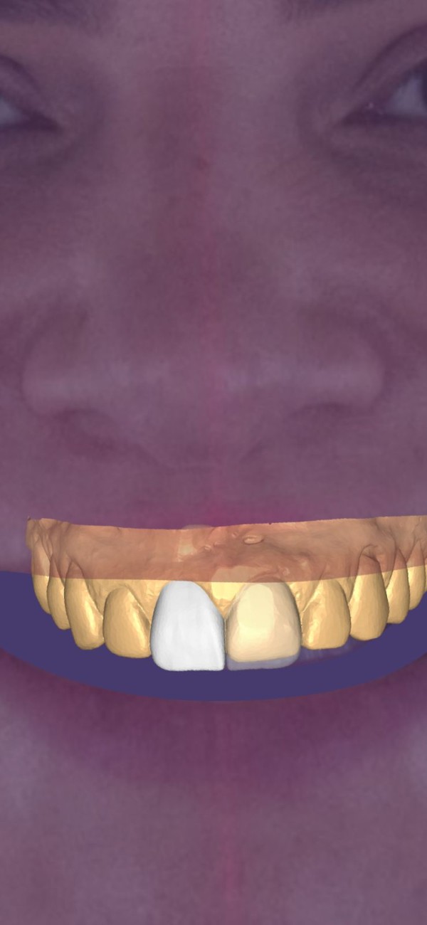 Imagem da etapa 2 do procedimento de lente de contato dental