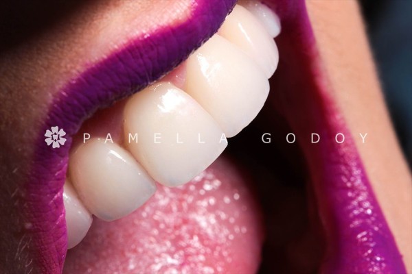 Imagem 5 das características para obter um sorriso bonito