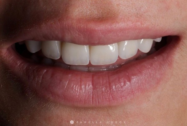 Imagem 6 das características para obter um sorriso bonito