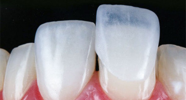 Imagem da etapa 4 do procedimento de lente de contato dental