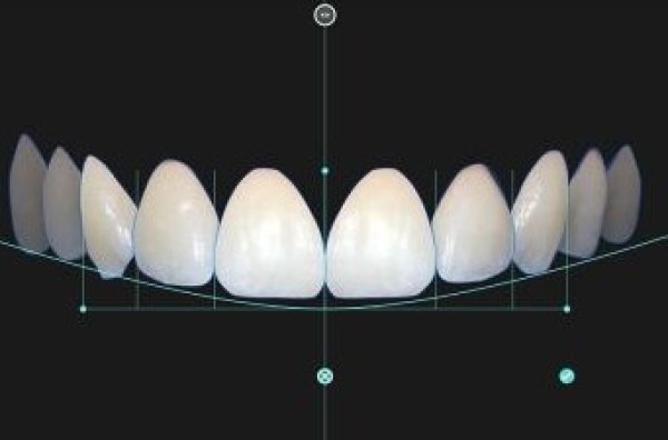 Imagem da etapa 3 do procedimento de lente de contato dental