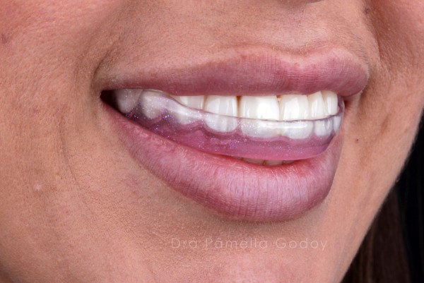 Imagem da etapa 3 do procedimento de implante dentário