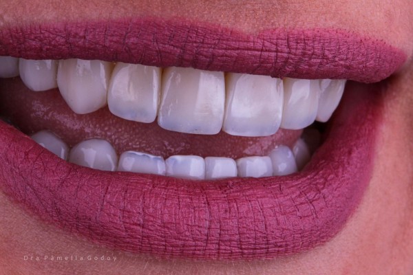 Imagem da etapa 4 do procedimento de implante dentário