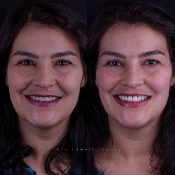 Antes e depois de Francine