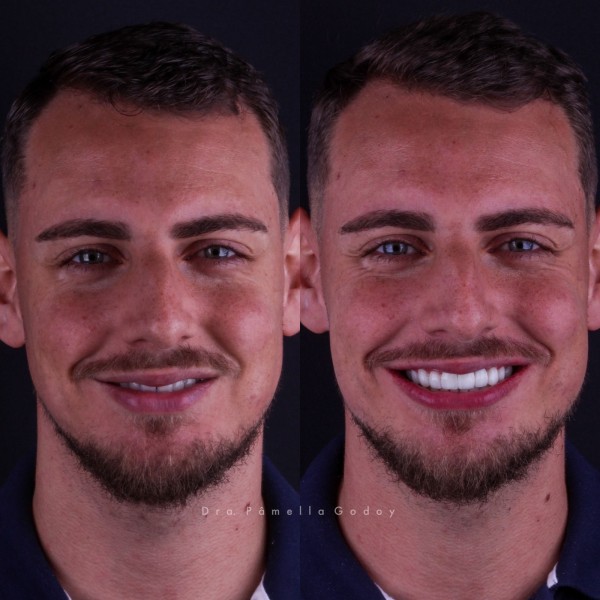 Antes e depois de Ruan