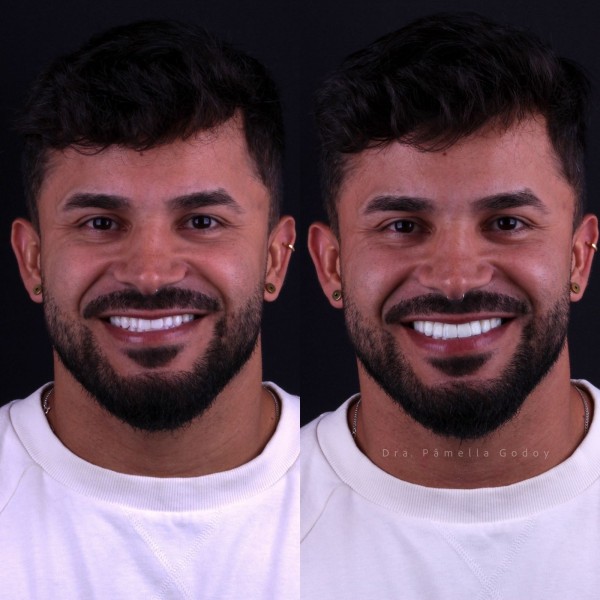 Antes e depois de Bruno