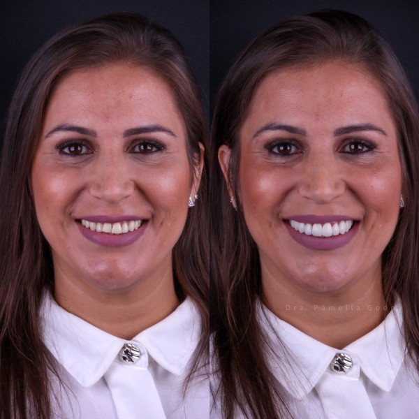 Antes e depois de Ana Paula