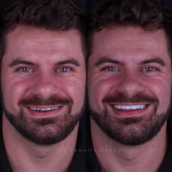 Antes e depois de Cassiano