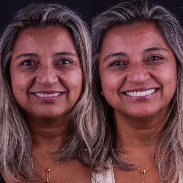 Antes e depois de Cleni