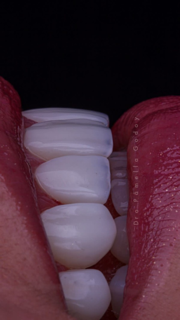 Imagem 5 das características para obter um sorriso bonito