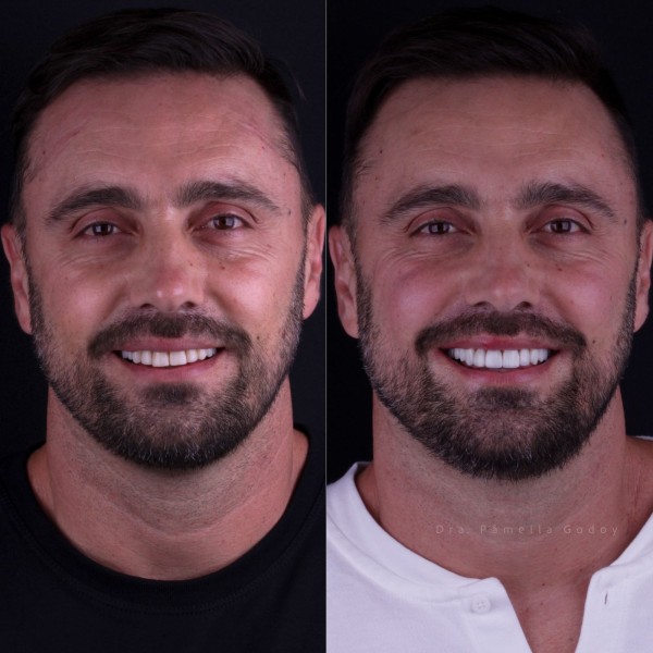 Antes e depois de Marcelo