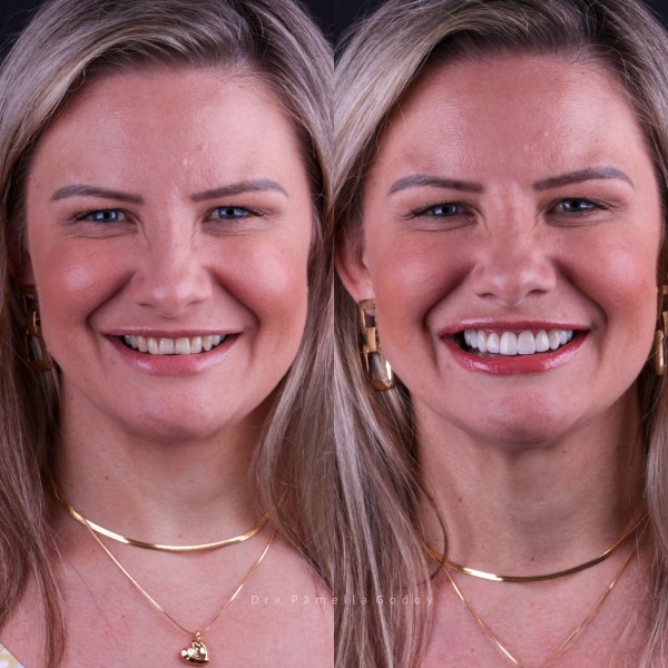 Antes e depois de Vanessa