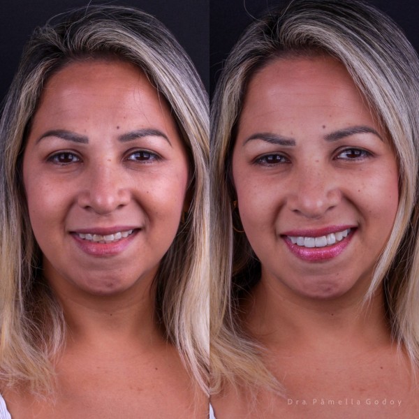 Antes e depois de Jaqueline