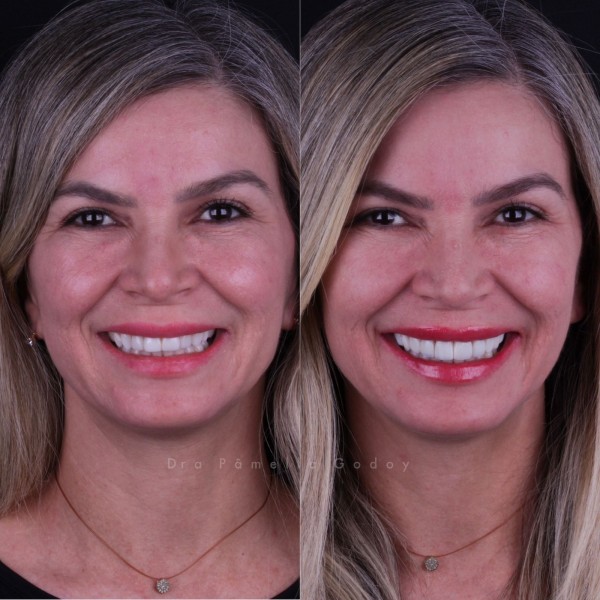 Antes e depois de Kayte