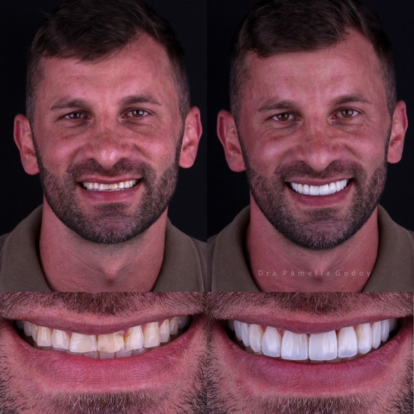 Antes e depois de Leandro