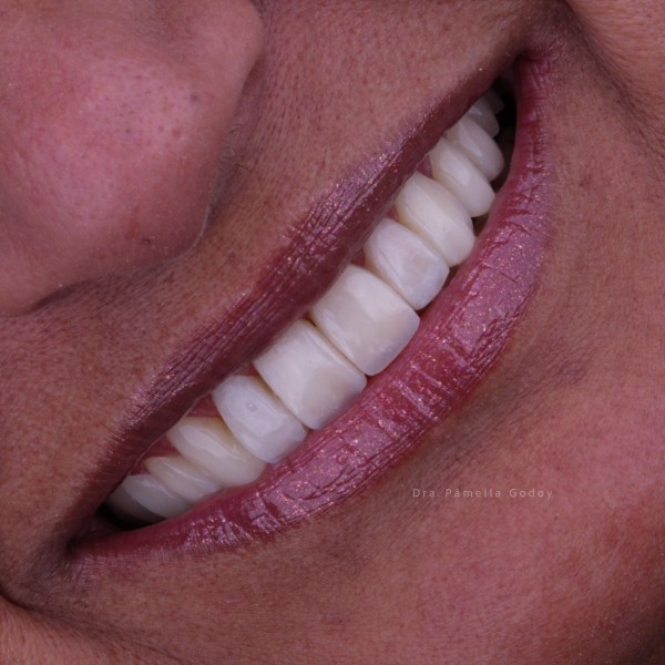 Imagem 6 das características para obter um sorriso bonito