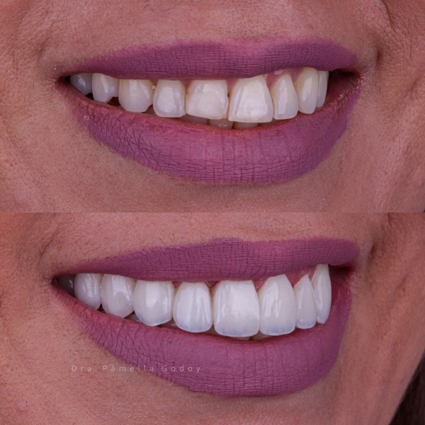 Imagem 2 das características para obter um sorriso bonito