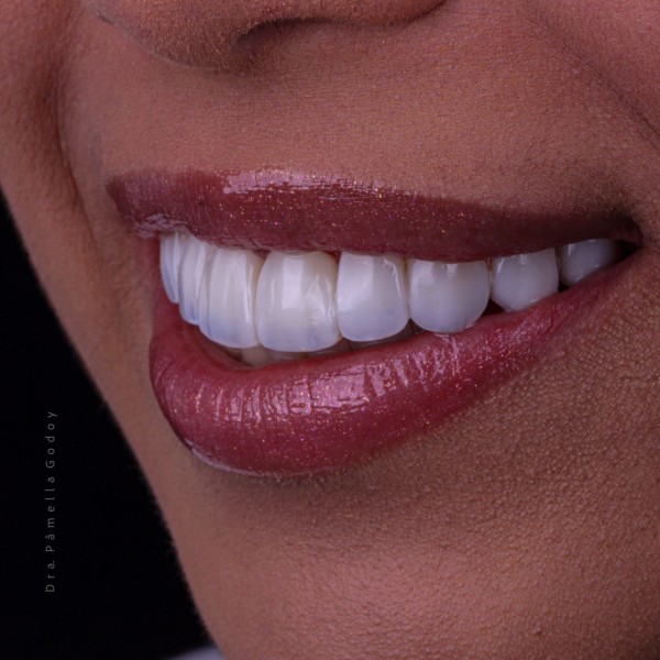 Imagem 3 das características para obter um sorriso bonito