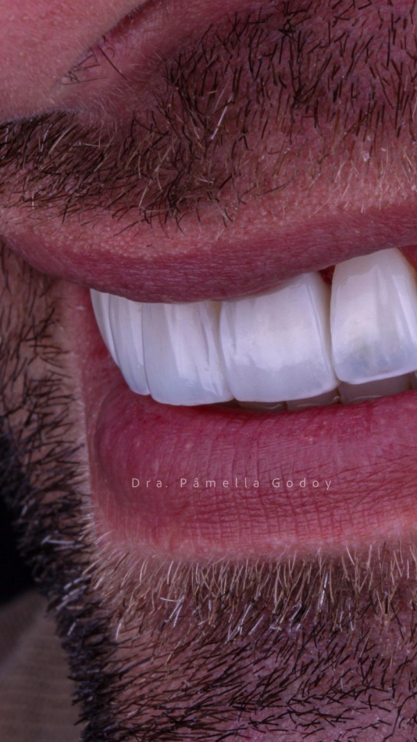 Imagem 1 das características para obter um sorriso bonito