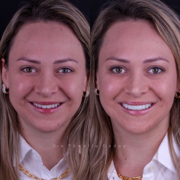 Antes e depois de Tanise